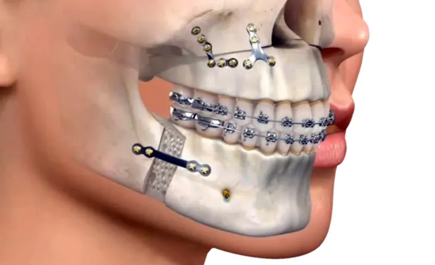 Surgical Orthodontics