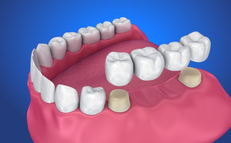 Tooth Replacement