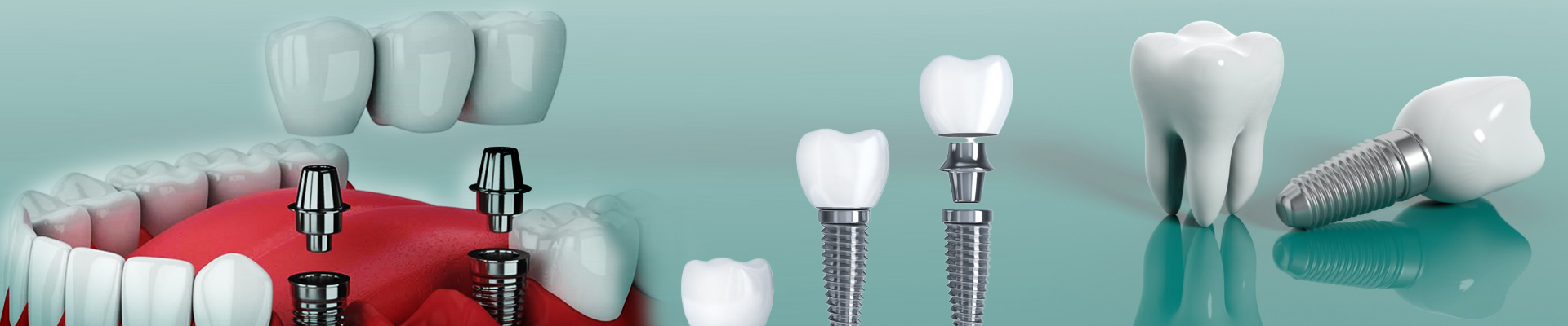 Dental Implants in Warangal