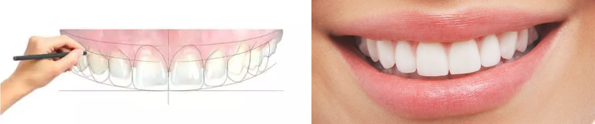 Dental Aesthetics