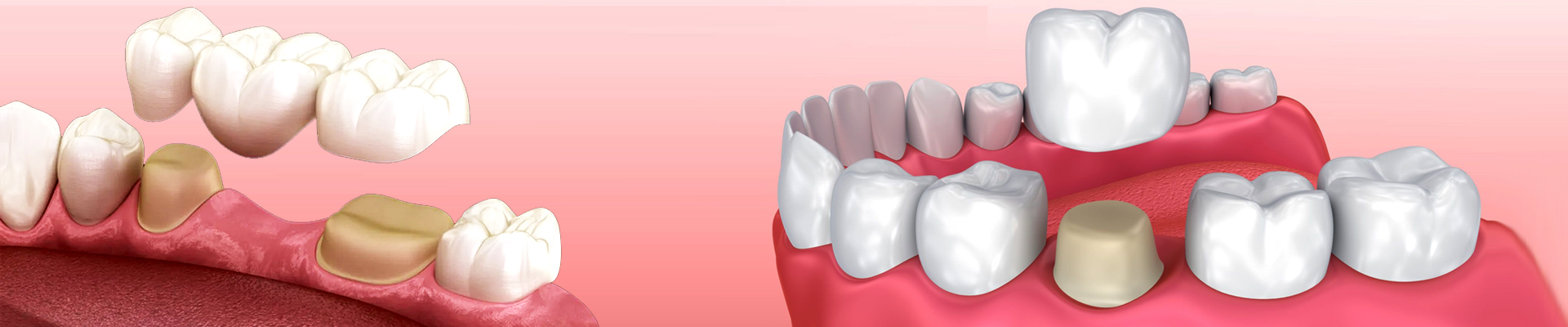 Dental Restoration