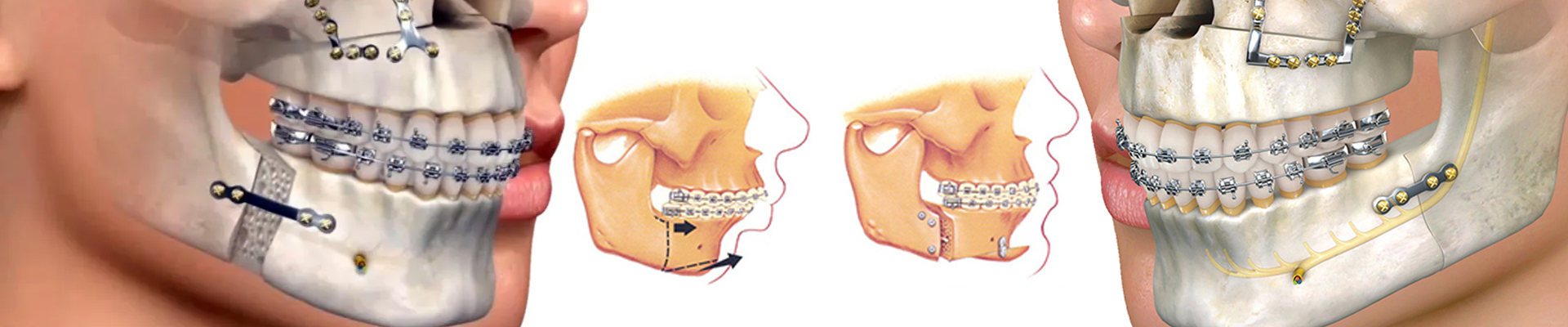 Facial Reconstruction