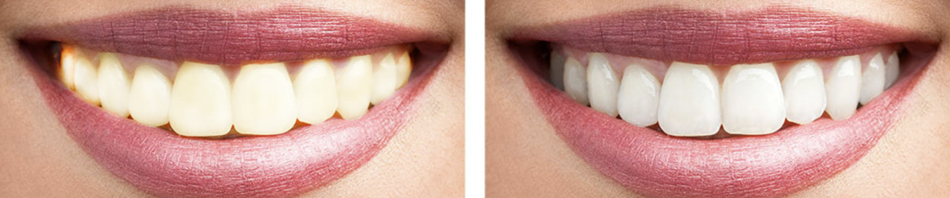 Teeth Whitening