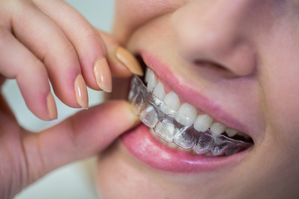 Invisalign vs Traditional Braces in Hanamkonda