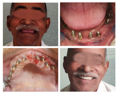 Before after dental