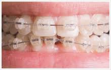 Ceramic Braces