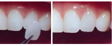 Design Veneers