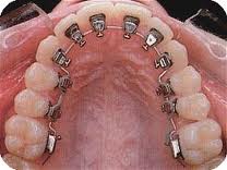 Invisible Braces