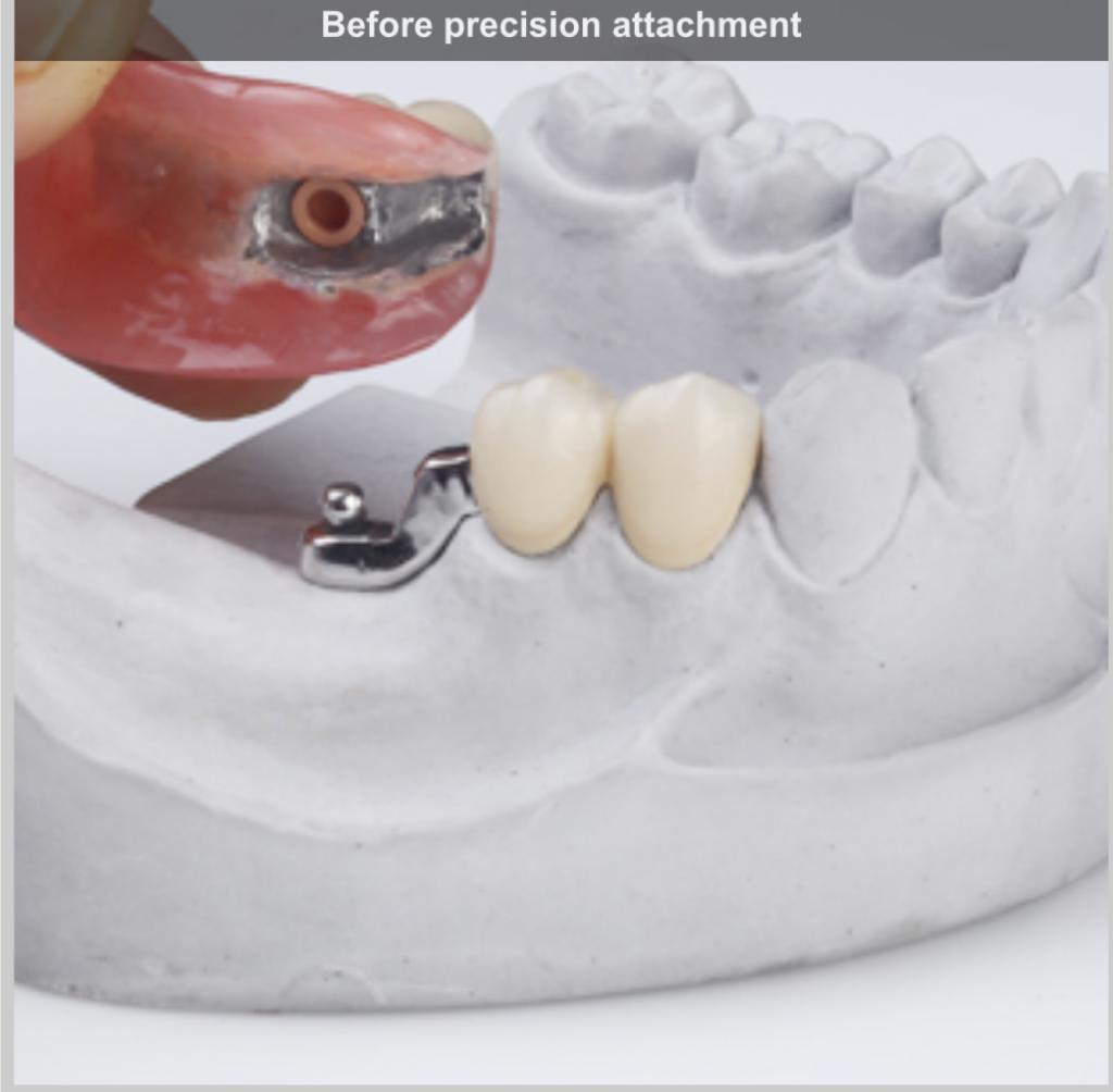 Precision Attachment