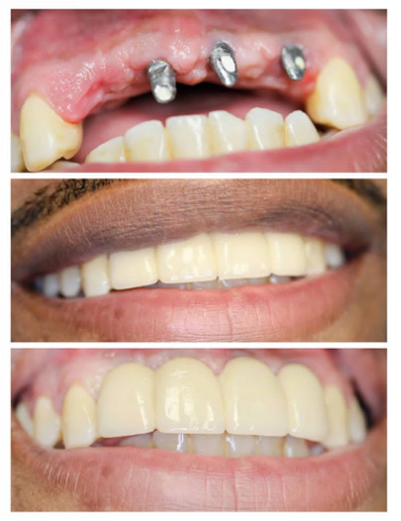 Tooth replacement