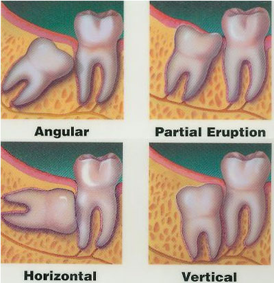 Wisdom Tooth