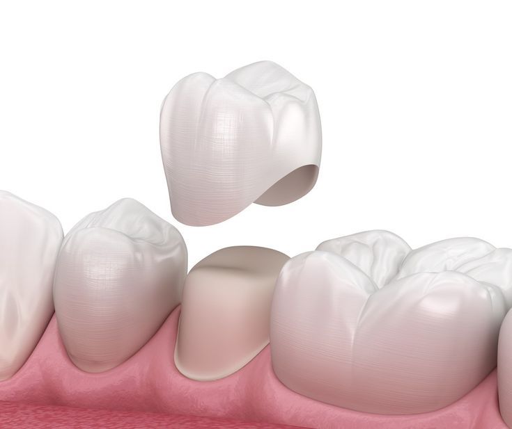 Best Dental Crown & Bridge Treatment in Hanamkonda