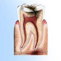 Wisdom tooth extraction in Warangal