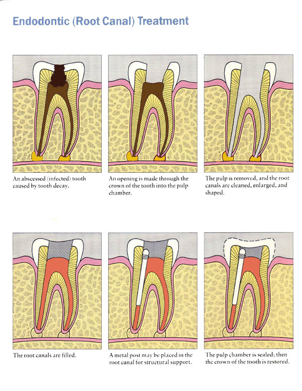 Root Canal Treatment in Hanamkonda